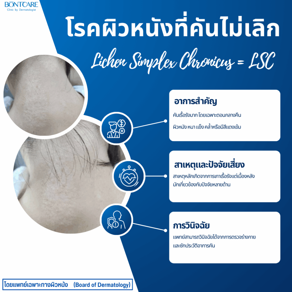 โรคผิวหนังที่คันไม่เลิก