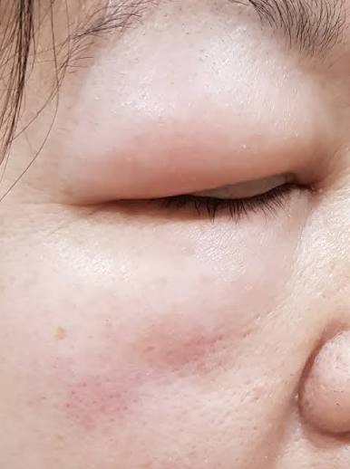 อาการบวมที่หนังตาและริมฝีปากจากภาวะ Angioedema ร่วมกับลมพิษ