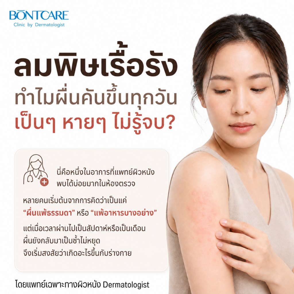 ผื่นลมพิษนูนแดงคันบนผิวหนัง อาการลมพิษเรื้อรัง